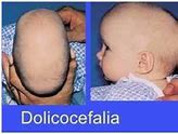 Image result for dolicocefalia