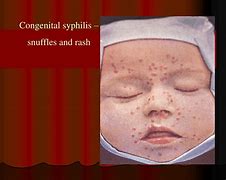 Image result for Congenital Syphilis