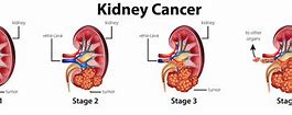 Image result for Cancer Kidney Renal Cell Carcinoma