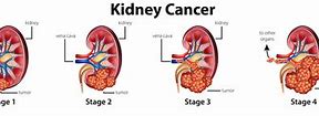 Image result for Kidney Cancer Tumor