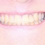 Image result for Peg Lateral Incisors