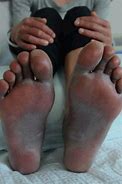 Image result for Fifth Disease Rash Legs