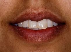 Image result for Crooked Front Teeth