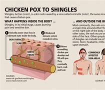 Image result for Shingles Pox