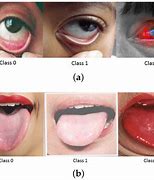 Image result for Anaemia Pallor
