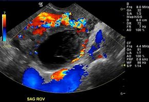 Image result for 5 Cm Cyst On Ovary
