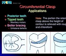 Image result for Circumferential Clasp