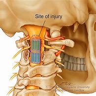 Image result for Spinal Cord Surgery