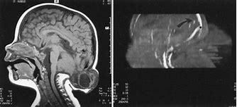 Image result for Occipital Encephalocele