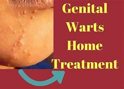 Image result for Genital Wart Tretment
