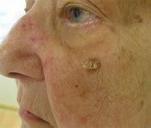 Image result for Squamous Cell Neck Cancer