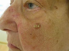 Image result for Squamous Cell Skin Cancer Symptoms