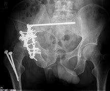 Image result for Hairline Fractures iPhone