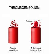 Image result for Thrombocytic Thrombotic Purpura