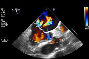 Image result for Cardiac Echo