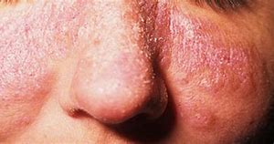 Image result for Lupus Skin Rash