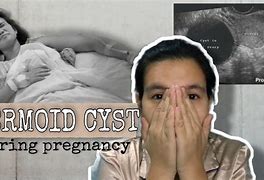 Image result for Dermoid Cyst during Pregnancy