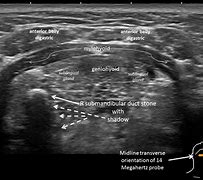Image result for Salivary Gland Stone Ultrasound
