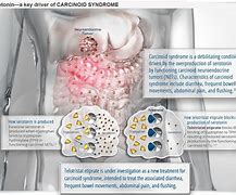 Image result for Cure for Carcinoid Tumor