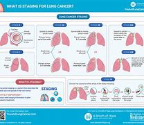 Image result for Lung Tumor Size Chart