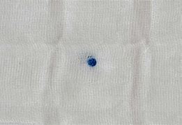 Image result for Blue Dot On Skin
