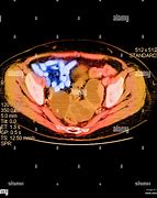 Image result for Twelve Pound of Ovarian Tumor