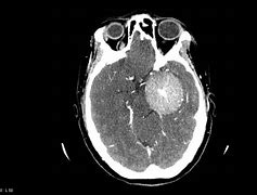 Image result for Meningioma CT Brain