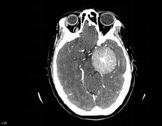 Image result for Meningioma Brain Tumor CT Scan