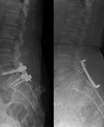 Image result for Lower Back Fusion Surgery