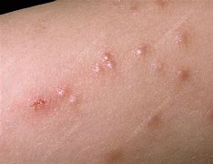 Image result for Molluscum Contagiosum in Gluteal Fold Treatment