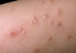 Image result for Molluscum On the Leg