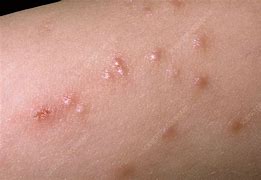 Image result for Molluscum Contagiosum Virus