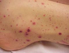 Image result for Sepsis Infection Symptoms