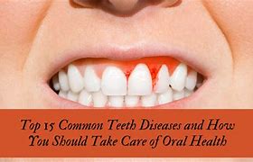 Image result for Teeth Gum Disease