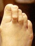 Image result for Overlapping Toes