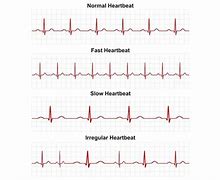 Image result for Abnormal Heart Rhythms Arrhythmias