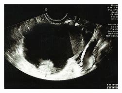 Image result for Complex Ovarian Cyst On Ultrasound