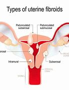 Image result for Female Fibroid Tumors in Uterus