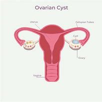 Image result for Ovarian Cyst Symptoms and Signs