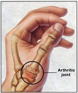 Image result for Thumb Joint Pain Treatment