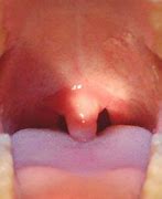 Image result for Growth On Uvula