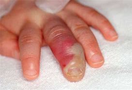 Image result for Herpetic Whitlow On Finger