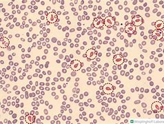 Image result for Myelofibrosis Peripheral Smear