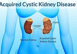 Image result for Cyst On Kidney Treatment