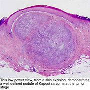 Image result for Kaposi Sarcoma Histology