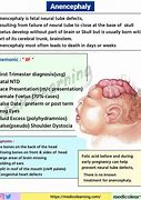 Image result for Pathophysiology of Anencephaly