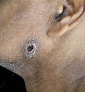 Image result for Ecthyma Cured Scar