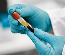 Image result for Ovarian Cancer Blood Tests