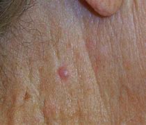 Image result for Skin Cancer Neck
