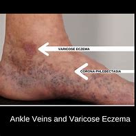 Image result for Ankle Veins